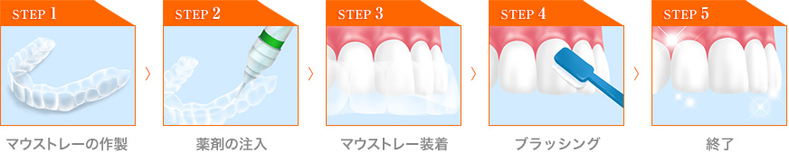 マウストレーの作製→薬剤の注入→マウストレー装着→ブラッシング→終了